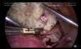Fibroma cervical anterior