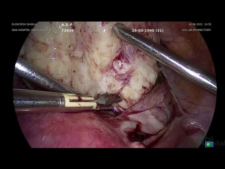 Fibroma cervical anterior