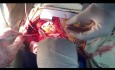Manejo de la Perforación de Muñón Aórtico después de Reparación de Válvula Mitral (MVR) en UCI OH