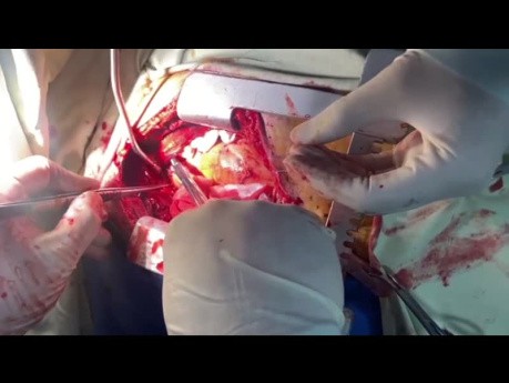 Manejo de la Perforación de Muñón Aórtico después de Reparación de Válvula Mitral (MVR) en UCI OH