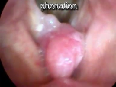 Pólipo de cuerda vocal verdadera sésil: movimientos espontáneos durante la respiración