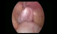 Orquiopexia laparoscópica bilateral