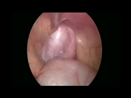 Orquiopexia laparoscópica bilateral