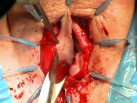 Uretroplastia de mucosa bucal con preservación del músculo bulbocavernoso