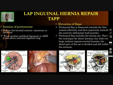 Reparación Laparoscópica de Hernia Inguinal