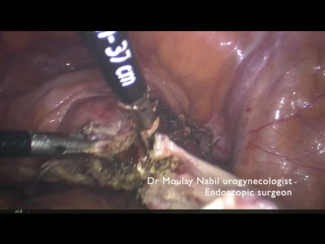 Sacrocolpopexia para el prolapso urogenital