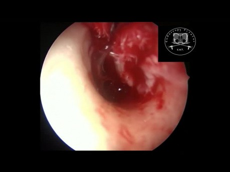Miringoplastia endoscópica
