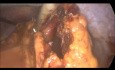 Colectomía subtotal laparoscópica, enfermedad inflamatoria intestinal