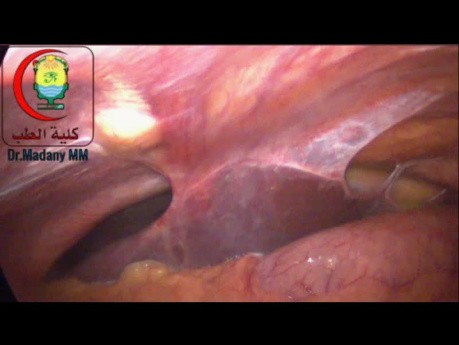 Adherencias entre los lóbulos hepáticos fusionados y la pared abdominal anterior