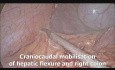 Proctocolectomía Laparoscópica Total con Anastomosis con Bolsa Ileoanal (IPAA)