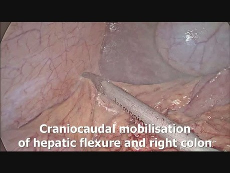 Proctocolectomía Laparoscópica Total con Anastomosis con Bolsa Ileoanal (IPAA)
