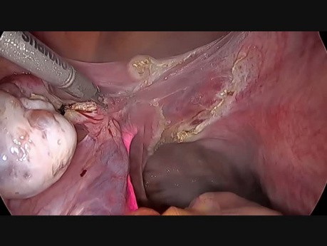 Histerectomía total laparoscópica con colocación de stent ureteral