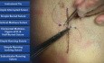 Punto colchonero vertical - técnicas de sutura