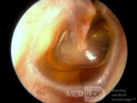 Nivel hidroaéreo de otitis serosa