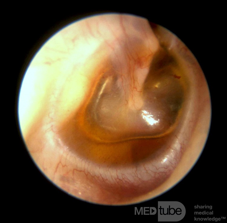 Nivel hidroaéreo de otitis serosa