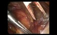Reparación laparoscópica TEP para hernia de vejiga