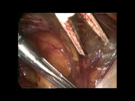 Reparación laparoscópica TEP para hernia de vejiga