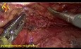 Esofagectomía toraco-laparoscópica - Parte torácica 4