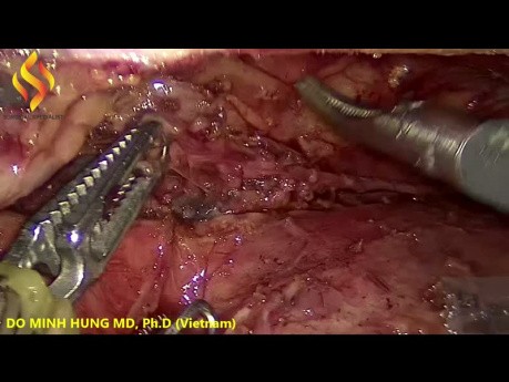 Esofagectomía toraco-laparoscópica - Parte torácica 4