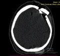 Estirpación de cavernoma subcortical 
