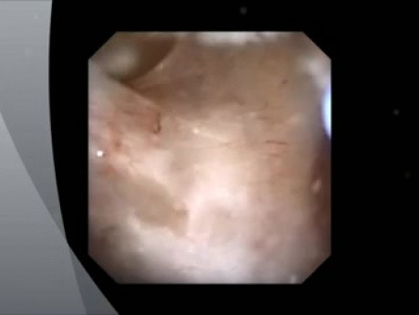 Cirugía retrógrada intrarrenal (RIRS) - dilatación de estenosis ureteral posrecurrente, exploración de hidroureteronefrosis