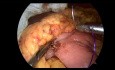 Anastomosis gastroyeyunal laparoscópica de 3 trócares con Braun enteroenterostomía
