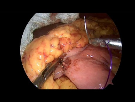 Anastomosis gastroyeyunal laparoscópica de 3 trócares con Braun enteroenterostomía