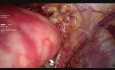 Funduplicatura laparoscópica de Nissen