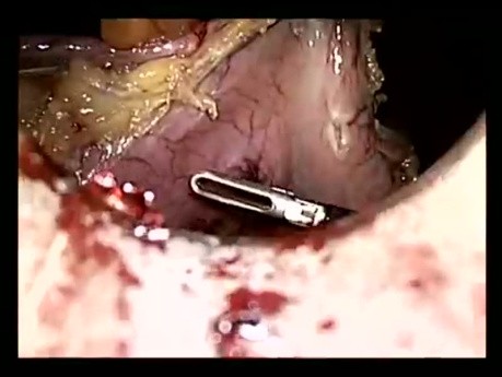 Gastrectomía vertical por laparoscopia | Tubo Gástrico
