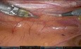 Cosecha robótica de la arteria mamaria interna 