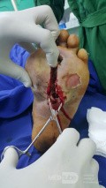 Úlcera del pie diabético con infección