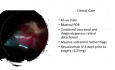 Hemorragia subretiniana masiva y desprendimiento de retina (retinopatía diabética proliferativa)