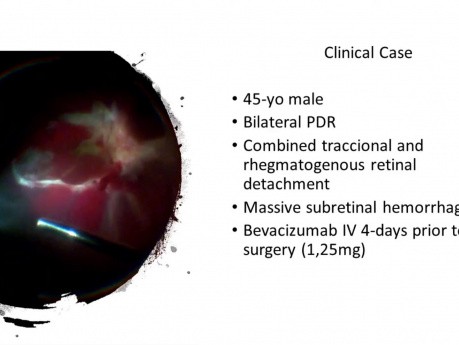Hemorragia subretiniana masiva y desprendimiento de retina (retinopatía diabética proliferativa)