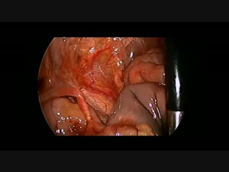 Resección laparoscópica de ovario intrauterino torcido en recién nacido