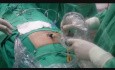 Técnica de hernia inguinal minilaparoscópica combinada TAPP y TEP