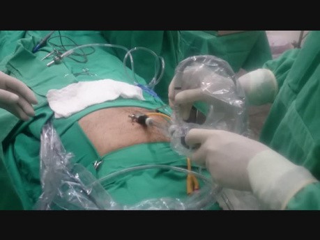 Técnica de hernia inguinal minilaparoscópica combinada TAPP y TEP