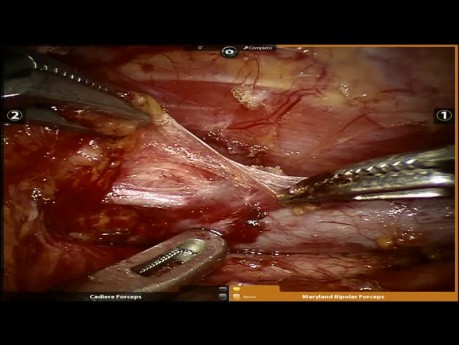 Abordaje torácico robótico para tratar el adenoma paratiroideo