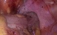 Sigmoidectomía laparoscópica con metastectomía hepática