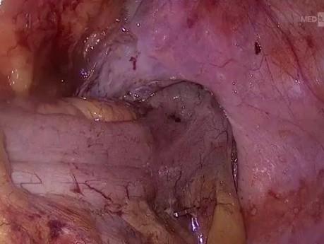 Sigmoidectomía laparoscópica con metastectomía hepática