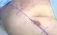 OrthoApproach - Abordaje deltopectoral de la articulación del hombro | Academia de Ortopedia
