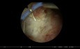 RTUV en bloque para cáncer de vejiga sobre orificio ureteral