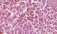 Hemocromatosis-hemosiderosis - histopatología - hígado, ganglio linfático