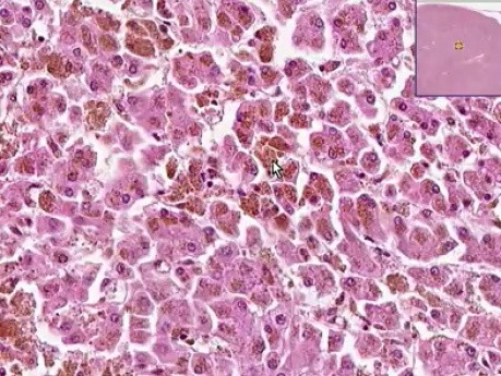 Hemocromatosis-hemosiderosis - histopatología - hígado, ganglio linfático