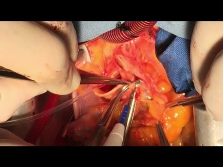 Operación de transposición de grandes arterias coronarias