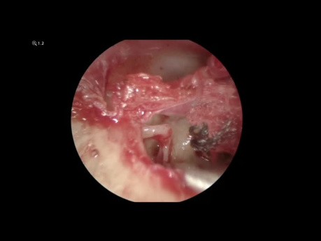 Estapedotomía Endoscópica Con Cierre de Ventana Oval Con Pericondrio