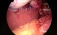 Extracción de la vesícula biliar - método SILS