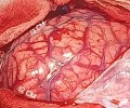 Craniectomía descompresiva en infarto maligno de la arteria cerebral media