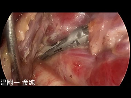 Cirugía endoscópica de tiroides transsubclavia de doble puerto (parte 5)
