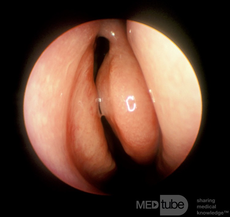 Sinusitis maxilar aguda [después del tratamiento]