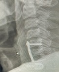 Abordaje Anterior de Cloward para Fractura Cervical AO Spine Tipo C con Síndrome de Brown Sequard